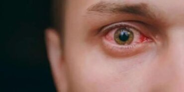 Adenovirüs belirtileri nelerdir? Adenovirüs nedir?