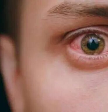 Adenovirüs belirtileri nelerdir? Adenovirüs nedir?