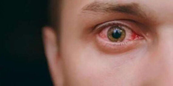 Adenovirüs belirtileri nelerdir? Adenovirüs nedir?