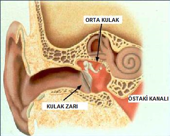 Orta Kulak İltihabı Belirtileri ve Tedavi Yolları