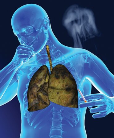 Akciğer Kanseri Nedir