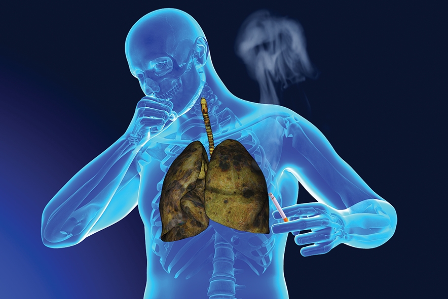 Akciğer Kanseri Nedir? Belirtileri ve Tedavi Yöntemleri