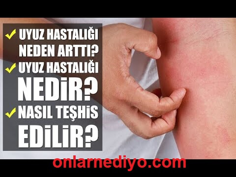 Uyuza ne iyi gelir? Evde uyuz hastalığı nasıl geçer?